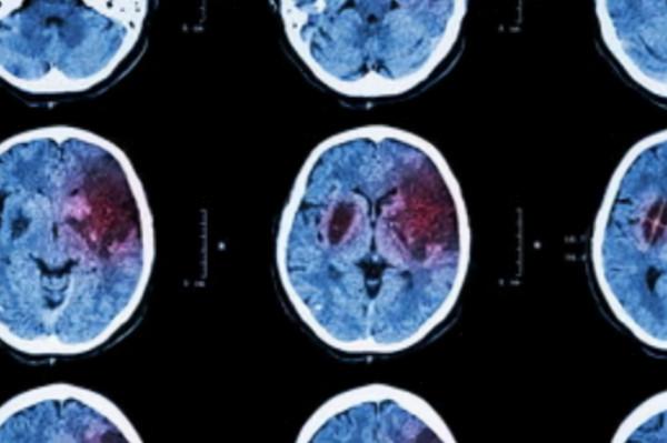 國產降壓藥阿利沙坦酯，保護心腎還可以降尿酸，幾乎不影響肝腎