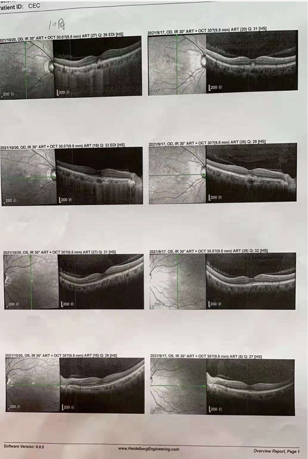 腦針見聞丨48歲女子飽受眼疾困擾，看東西像“蒙了一層紗”