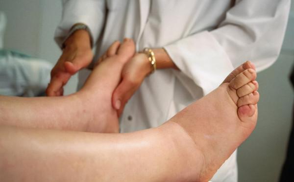 54歲女士泡腳發現腿腫，沒當回事，後來去醫院檢查，結果如何？