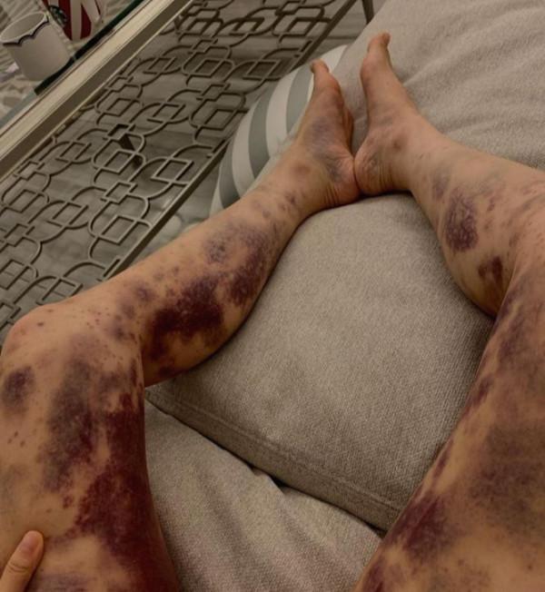 韓女星注射美容針全身瘀血，“問我胸腔打沒打針，像車禍一樣痛”