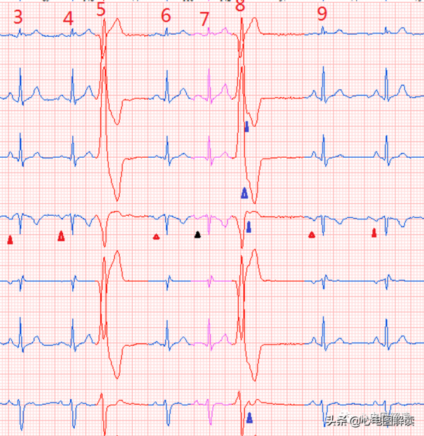 室性早搏?房性早搏?室房逆傳? 室性早搏?房性早搏?室房逆傳?