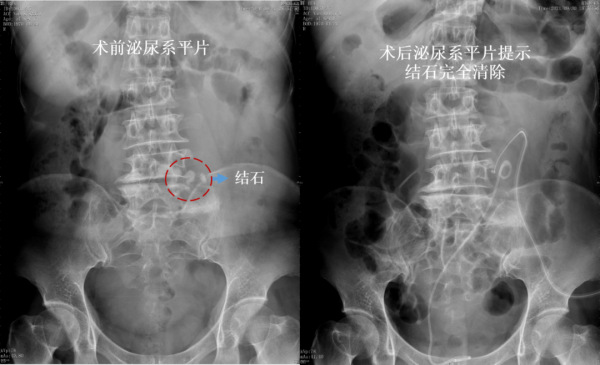 不走尋常“路” 清華長庚泌尿外科為異位腎患者解除腎結石