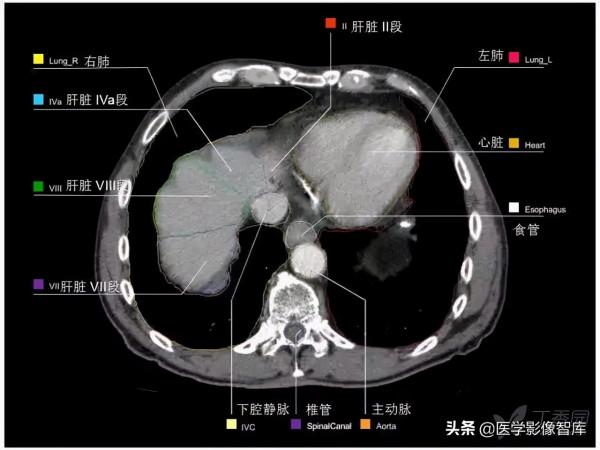 CT斷層解剖圖譜最全總結「推薦收藏」 CT斷層解剖圖譜最全總結「推薦收藏」