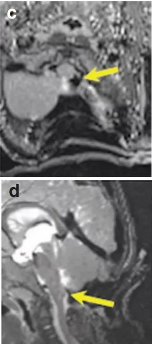 手術全切,3年未復發,1歲多幼兒如何鬥過腦幹膠質瘤“惡魔”? 手術全切,3年未復發,1歲多幼兒如何鬥過腦幹膠質瘤“惡魔”?