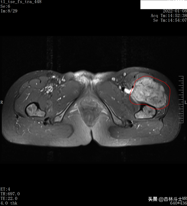 中年女性，兩年連續多次預警不重視，再次檢查發現腫瘤已是晚期了