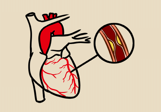 心血管疾病常用的6種檢查方法，這篇全說透了