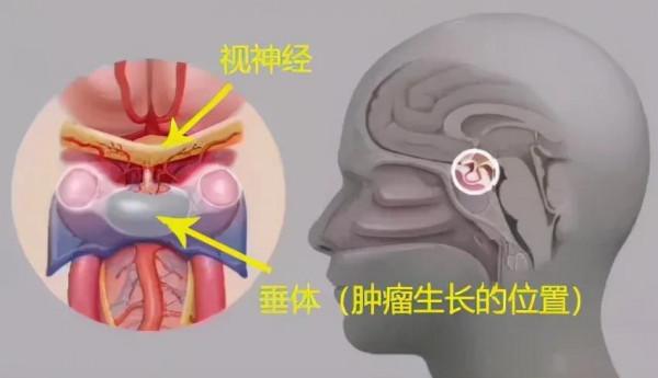 44歲加拿大華人萬里求醫，神外專家妙手除疾