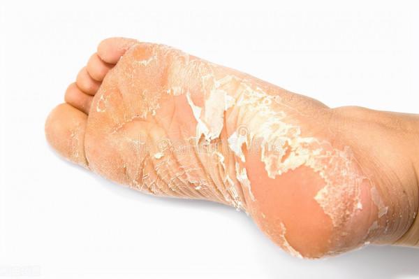 醫生教你三個小妙招,搞定冬季手腳開裂 醫生教你三個小妙招,搞定冬季手腳開裂