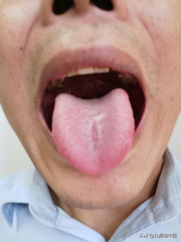 腎結石是常見病,看看中醫怎麼治好的,有B超對比為證 腎結石是常見病,看看中醫怎麼治好的,有B超對比為證