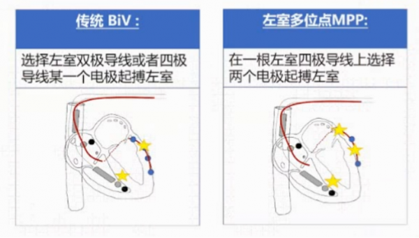 室性心律失常的新進展,你瞭解多少?|GW-ICC 2021 室性心律失常的新進展,你瞭解多少?|GW-ICC 2021
