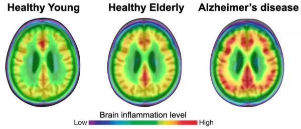 神經炎症促發阿爾茨海默病？新研究首次在活人大腦中找到證據