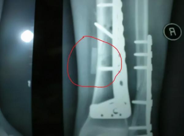 骨折後,鋼板不取出留在體內會怎樣?有沒有副作用? 骨折後,鋼板不取出留在體內會怎樣?有沒有副作用?