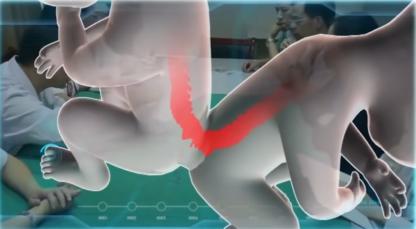 連體兒分離手術難度有多高？江西女嬰臀部相連，唯一的肛門咋分？