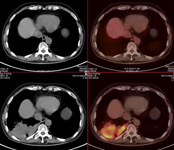 PET/CT病例（1）：晚期肺癌治療3個月，老人重現希望和曙光