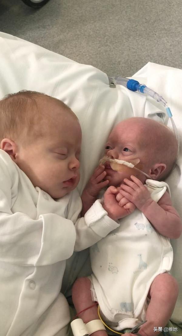 倆胎兒在媽媽子宮裡搶食，弟弟出生時不到1斤重，奇蹟般活了下來