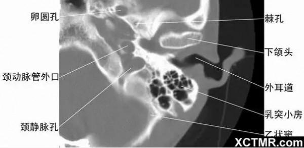 頭頸五官CT斷層解剖圖及常見病影像診斷