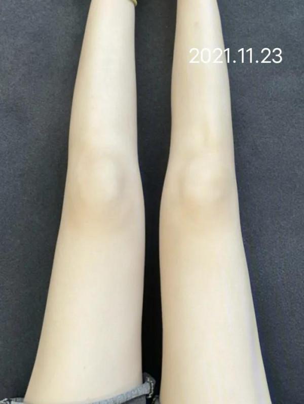 鍛鍊長了肥胖紋？遇見這套東西心不慌了