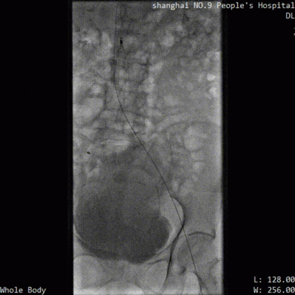 血栓清除率超90％，取出亞急性血栓，樂奧醫療靜脈取栓導管新突破