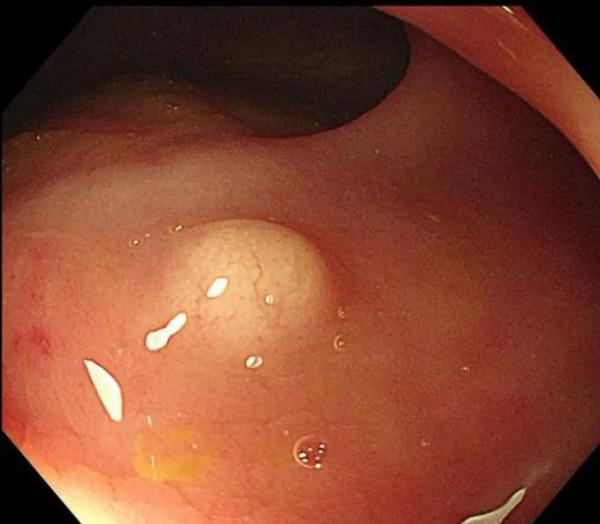酷似良性息肉的類癌 酷似良性息肉的類癌