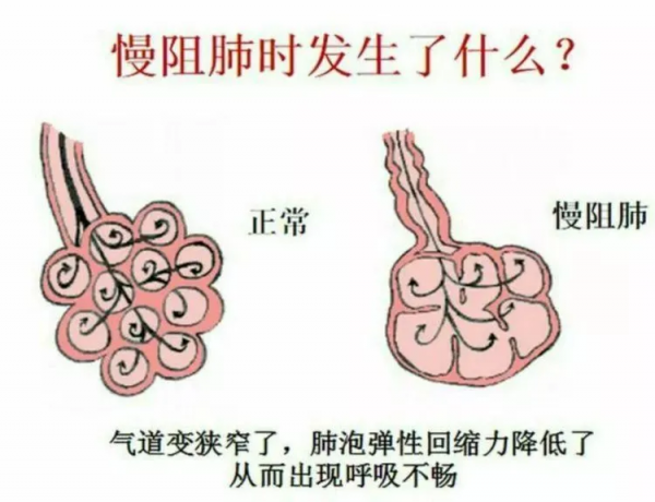 張少華老師因慢性阻塞性肺病去世，普通人如何預防慢阻肺？