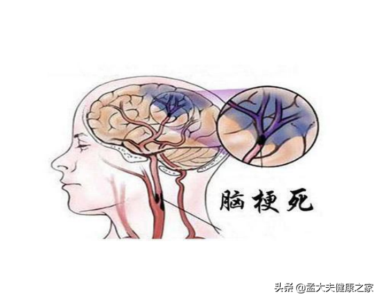長期服用阿司匹林和他汀，是在治療腦梗死嗎，真正目的是什麼？