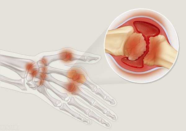 3個跡象表明你有類風溼關節炎，現在知道還不晚