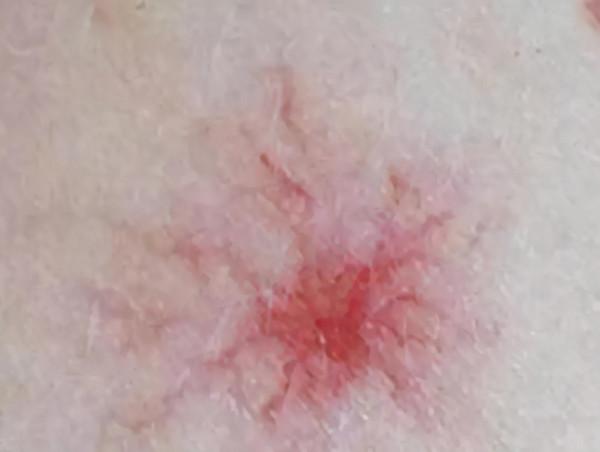 奪走趙忠祥生命的鱗狀細胞癌,聽起來陌生,實際上卻很常見 奪走趙忠祥生命的鱗狀細胞癌,聽起來陌生,實際上卻很常見