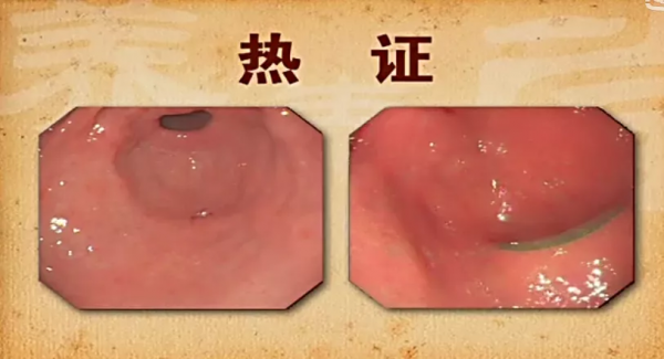 2步看出胃部問題，有這4種舌象的人要小心了