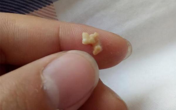 同學嫌棄兒子“嘴太臭”，媽媽帶孩子檢查，醫生取出的顆粒是真臭