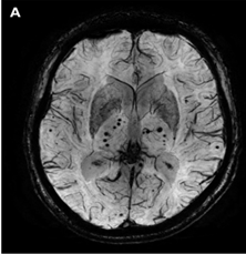 磁共振上出現腦微出血,這11種病因要考慮 磁共振上出現腦微出血,這11種病因要考慮