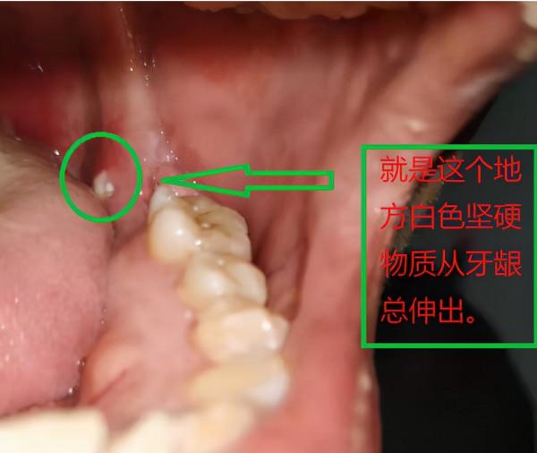 這算不算種植牙醫療事故? 這算不算種植牙醫療事故?