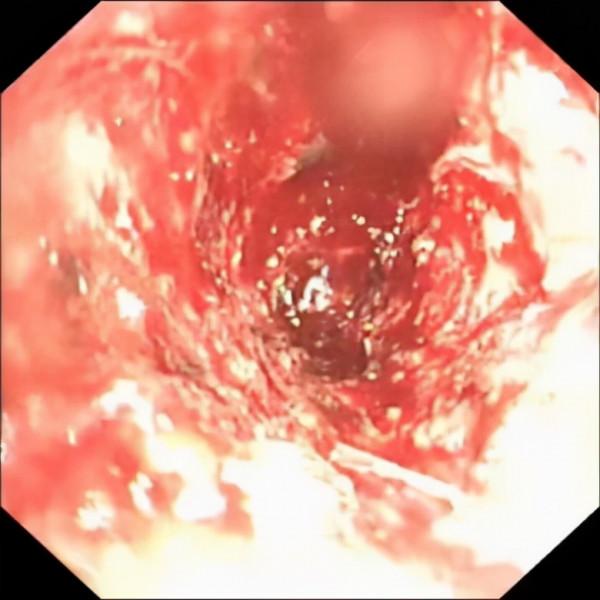 久咳不愈要警惕!六旬大爺拖成肺癌晚期 久咳不愈要警惕!六旬大爺拖成肺癌晚期