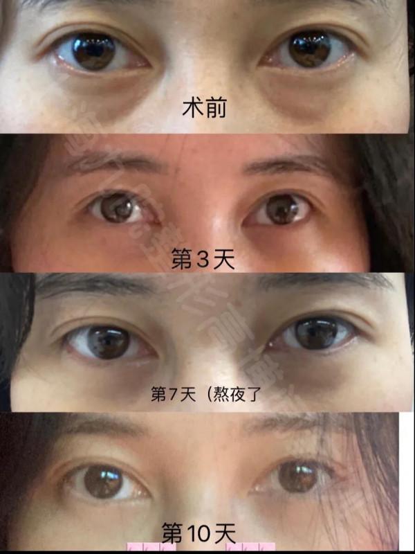 聽說你要做祛眼袋/眶隔釋放了?這些事你知道了嘛? 聽說你要做祛眼袋/眶隔釋放了?這些事你知道了嘛?