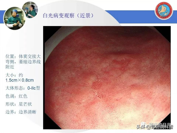 早期胃癌——內鏡診治流程