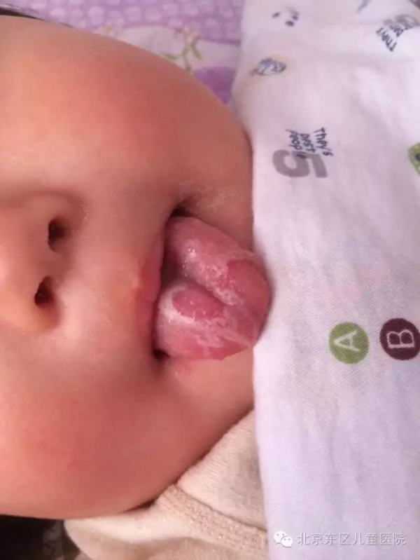 舌尖突然變紅，說明有心火