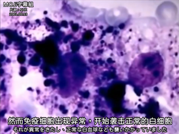 遭受核輻射的人體會有什麼變化?他堅持了83天,最後變成什麼樣了 遭受核輻射的人體會有什麼變化?他堅持了83天,最後變成什麼樣了