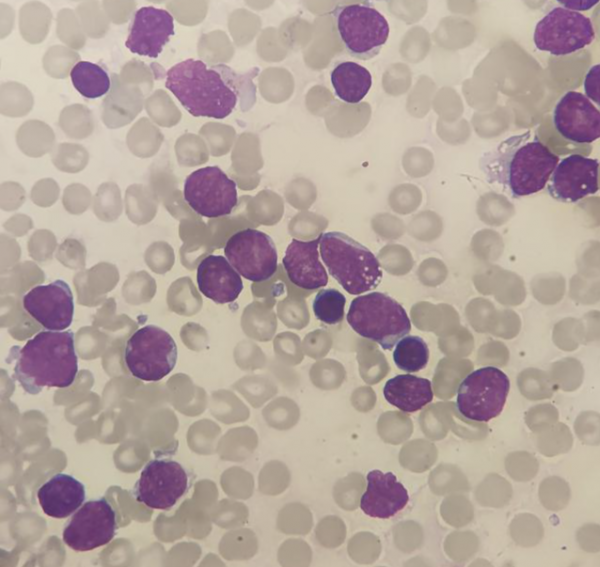 病例分享丨一例慢性髓系白血病急淋變的診斷過程