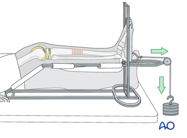 闢謠 |“吊脖子”可治頸椎病?醫生:危險,不可取 闢謠 |“吊脖子”可治頸椎病?醫生:危險,不可取