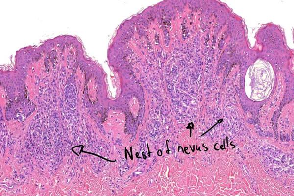 頭皮腫物（皮內痣）