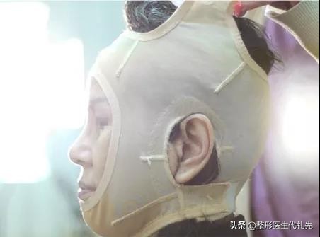 拉皮手術後7天的照片,腫脹、疼痛、面罩你想知道的都在這裡? 拉皮手術後7天的照片,腫脹、疼痛、面罩你想知道的都在這裡?