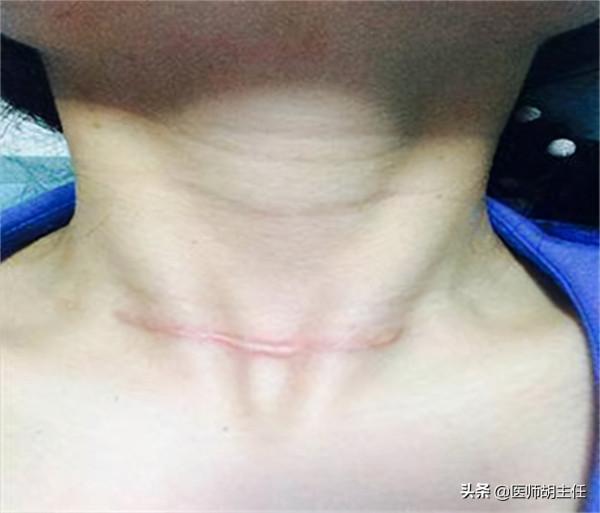 甲狀腺全切後，身體會發生怎樣的變化？哪些情況需要切除甲狀腺？