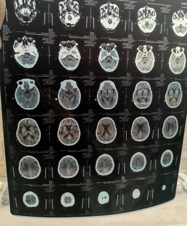 腦梗母親恢復效果超乎想象