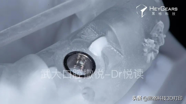 黑格科技丨病例分享：美學區即拔即種微創治療