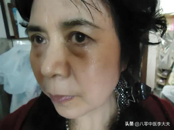 色斑,老年斑,嘴唇黑,胸口刺痛疼?血府逐瘀,活血化瘀,氣血旺 色斑,老年斑,嘴唇黑,胸口刺痛疼?血府逐瘀,活血化瘀,氣血旺