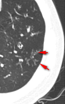 鼻子問題帶出肺病,17歲小夥咳嗽8年,氣管鏡吸出“一斤痰” 鼻子問題帶出肺病,17歲小夥咳嗽8年,氣管鏡吸出“一斤痰”