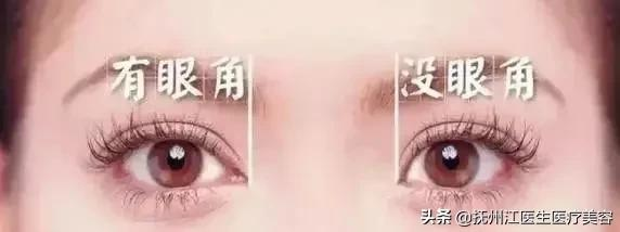 開眼角手術適合什麼樣的人群呢?丨科普篇 開眼角手術適合什麼樣的人群呢?丨科普篇