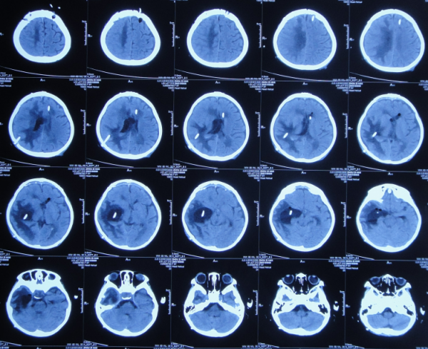 顱內生殖細胞瘤切除術後腦積水仍反覆,意識模糊,左側肢體偏癱 顱內生殖細胞瘤切除術後腦積水仍反覆,意識模糊,左側肢體偏癱