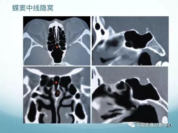 頭頸五官CT斷層解剖圖及常見病影像診斷
