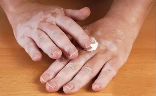 白癜風到了冬季病症減輕好轉，可以停藥嗎？