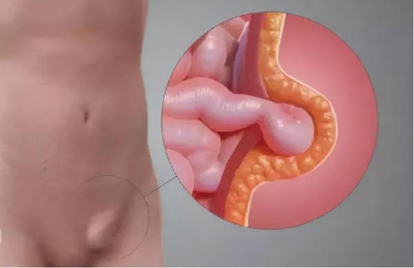 “孩子下面鼓了個包”，家有男寶寶，出現這個症狀別大意